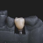 Ile kosztują implanty zębów