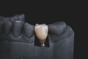 Ile kosztują implanty zębów