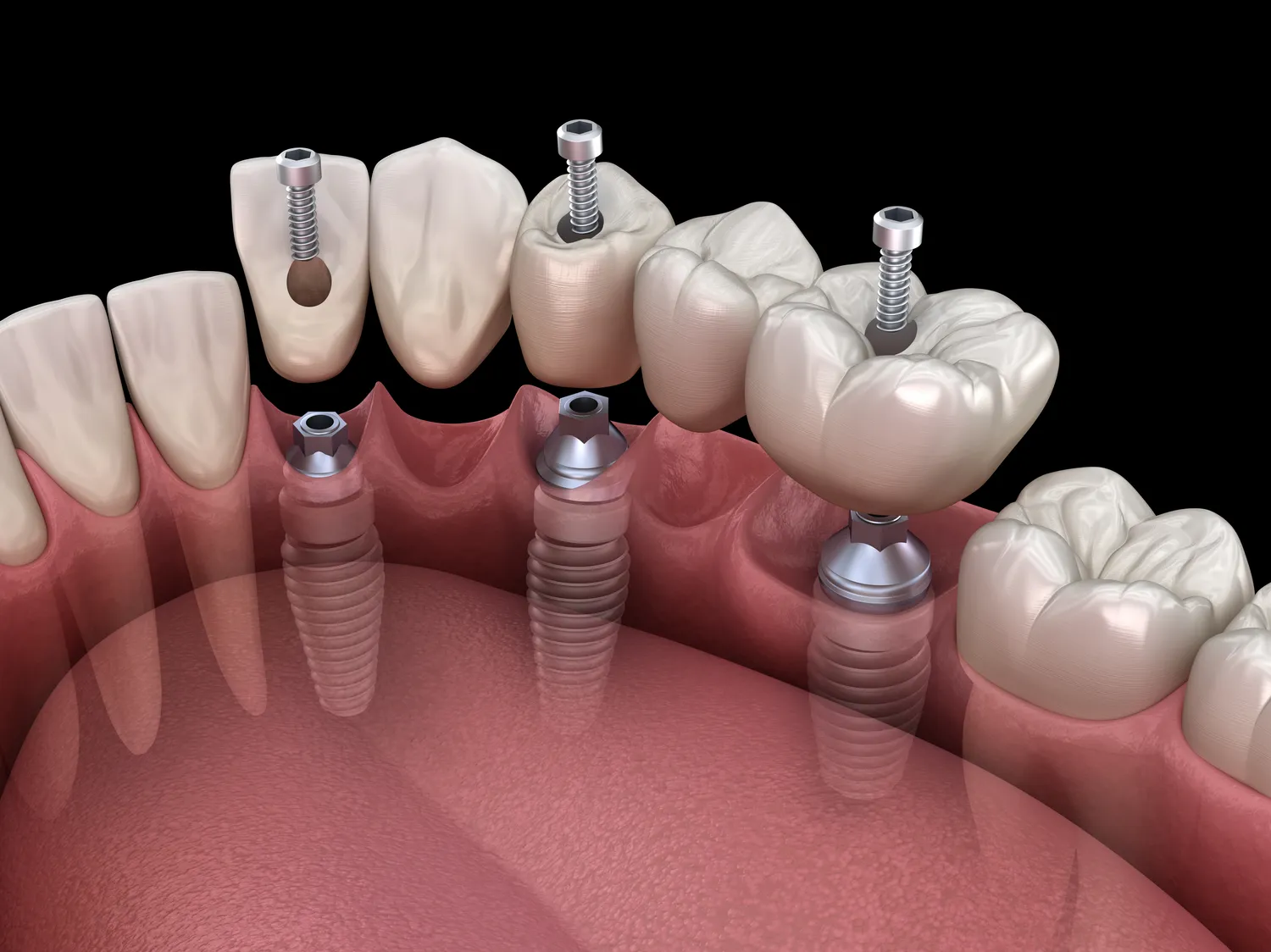 Dentysta Szczecin implanty